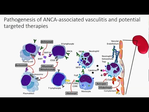 ANCA associated Vasculitis