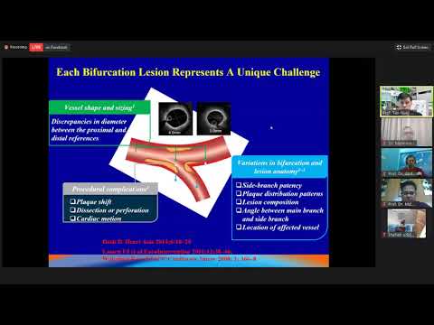 Step by step manual for planning and management of Bifurcation lesions