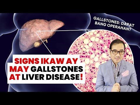 3 Signs na may FATTY LIVER at GALLSTONES ka! Dapat bang operahan? | DR TONY LEACHON