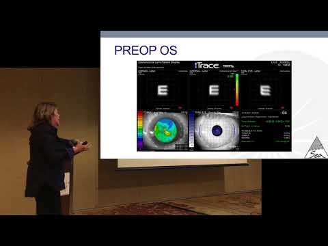ASCRS 18 (5) - Dr. Stephenson at the iTrace Users Meeting