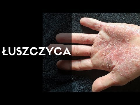 Początkowa faza deformacji Kości na kciukiem zatrzask nogi bez recepty