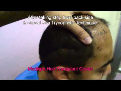 Hair Transplant procedure at medispa by Dr.Suneet Soni Delhi  Jaipur India UAE