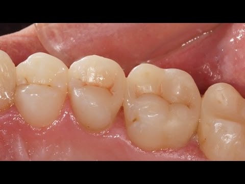 Прямая реставрация боковых зубов после эндодонтического лечения. Дмитрий Копылов