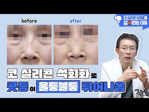 #코성형 후 울퉁불퉁해진 콧등!! 피부 천공까지 생길 수 있다고요..?
