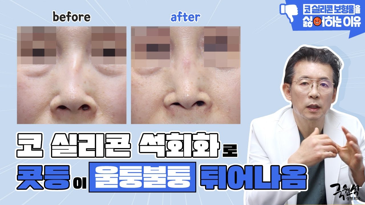#코성형 후 울퉁불퉁해진 콧등!! 피부 천공까지 생길 수 있다고요..? 썸네일