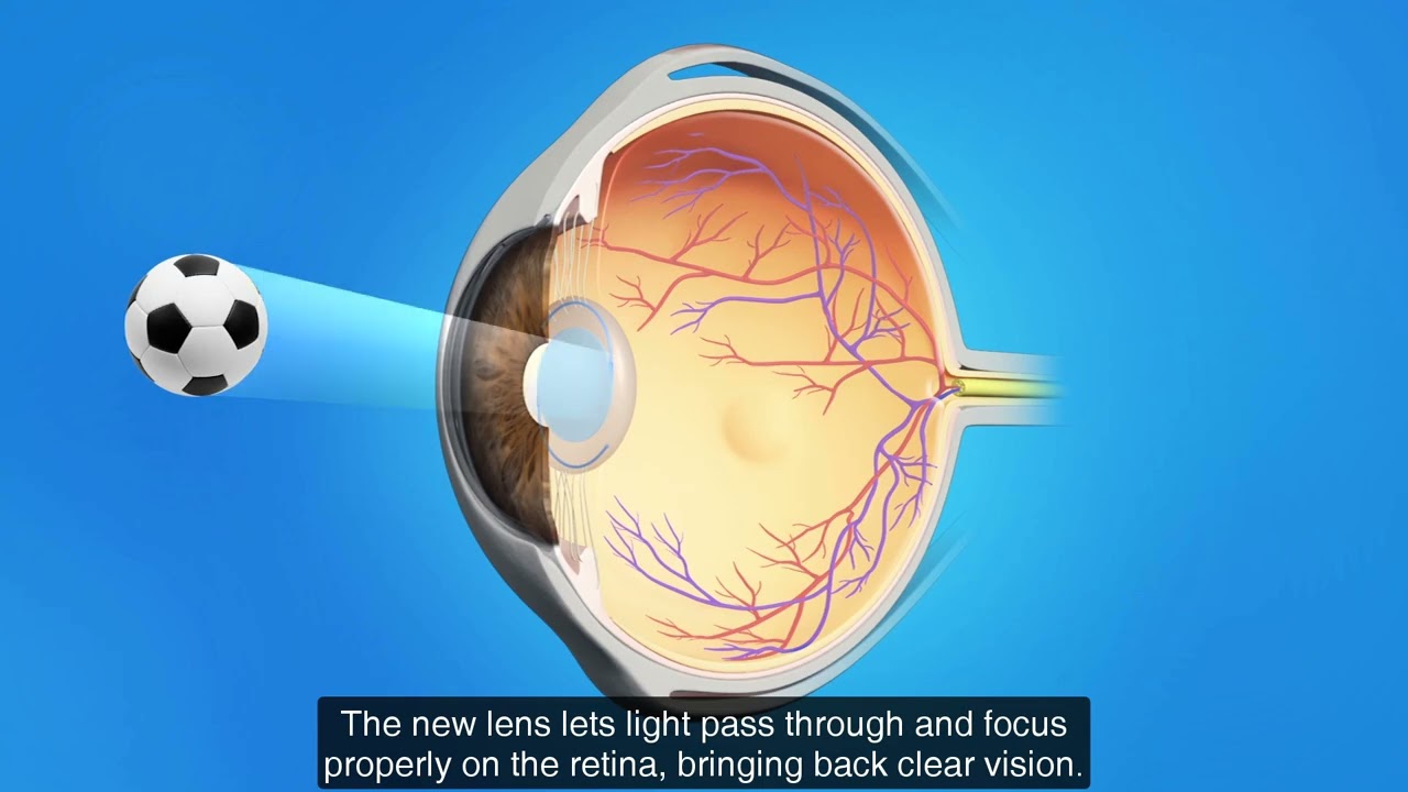 Phaco Refractive Lens Ex
