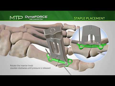 DynaForce Staple Compression Plates(SCP) for MTP Fusions