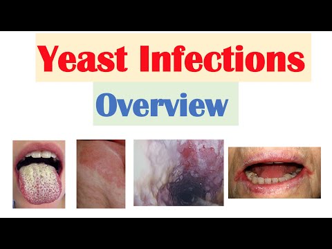 Candidal (Yeast) Infections Overview | Oral Thrush, Vaginal, Intertrigo, Esophageal Candidiasis