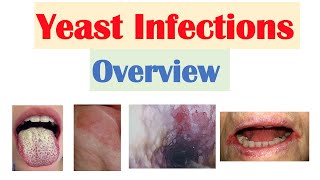 Download lagu Candidal Infections Overview Oral Thrush Vaginal I... mp3