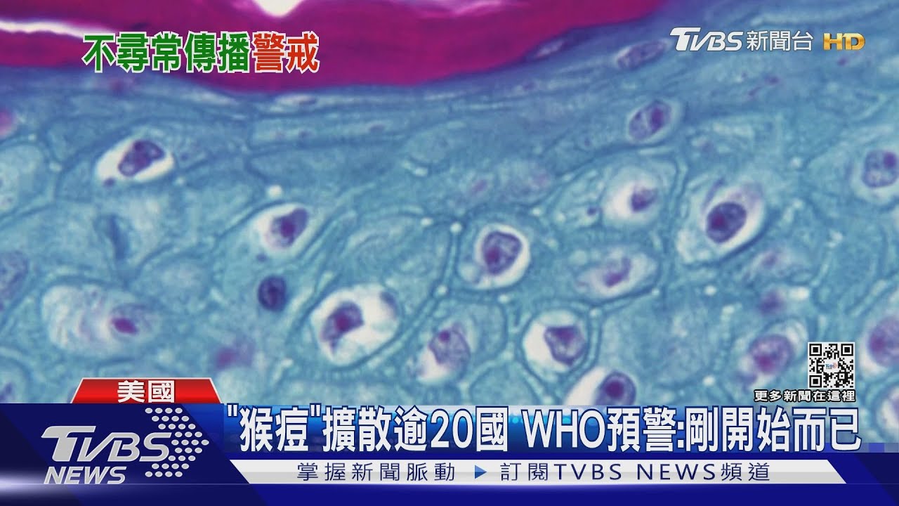 新公衛危機?「猴痘」擴散逾20國 WHO預警:剛開始而已