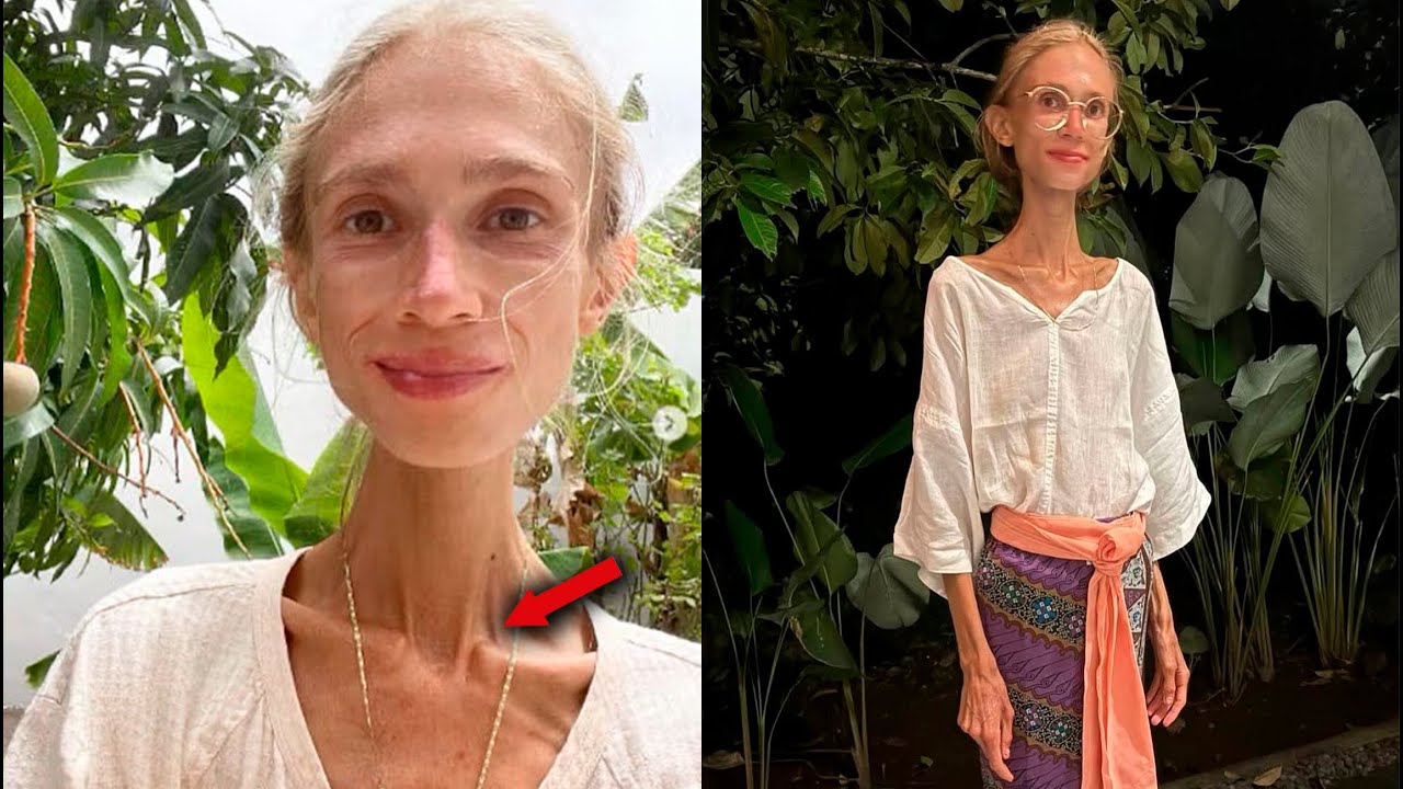 ¿Qué le pasó a la CHICA VEGANA que solo pesaba 22 KILOS?