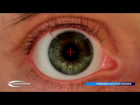 LASIK: ce ar trebui să știți despre operația de corectare a vederii | Glosar | Lentiamo