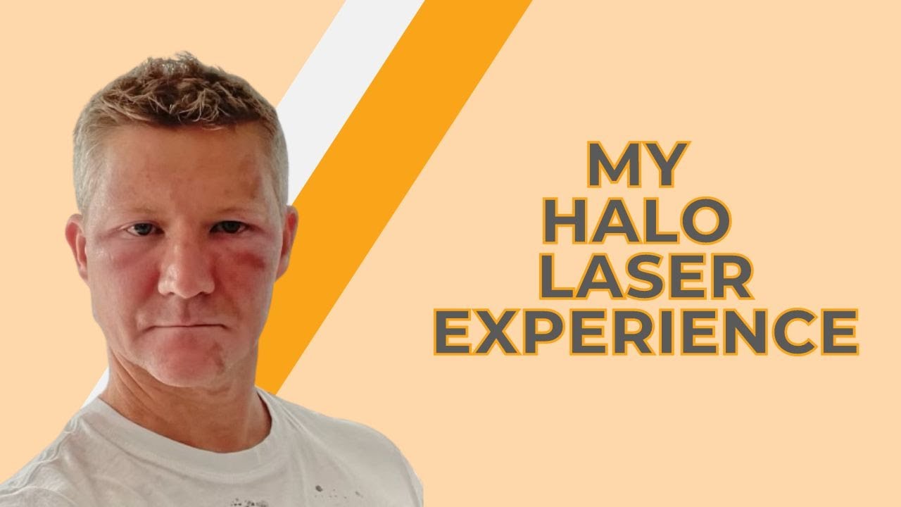 I’m a Plastic Surgeon, I had Halo Laser Treatment and Here’s What Happened (Part 1 of 3)
