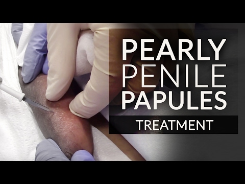 download lagu mp3 mp4 Fordyce Spots And Ppp, download lagu Fordyce Spots And Ppp gratis, unduh video klip Fordyce Spots And Ppp