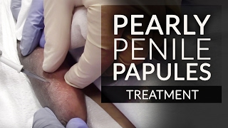 Get Rid of Pearly Penile Papules (PPP) | Fordyce Spot Removal Treatment by Dr. Jason Emer MD