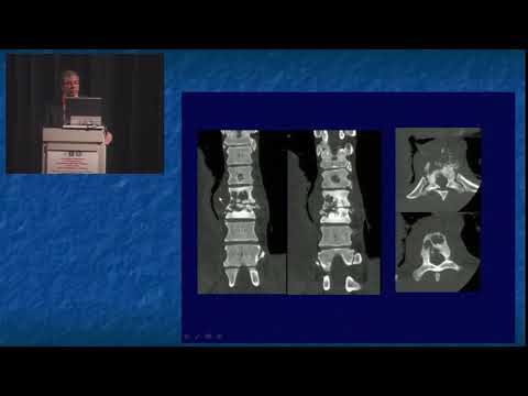 Se linfonodo infiammato nel osteocondrosi della colonna cervicale Se non si inserisce il giunto