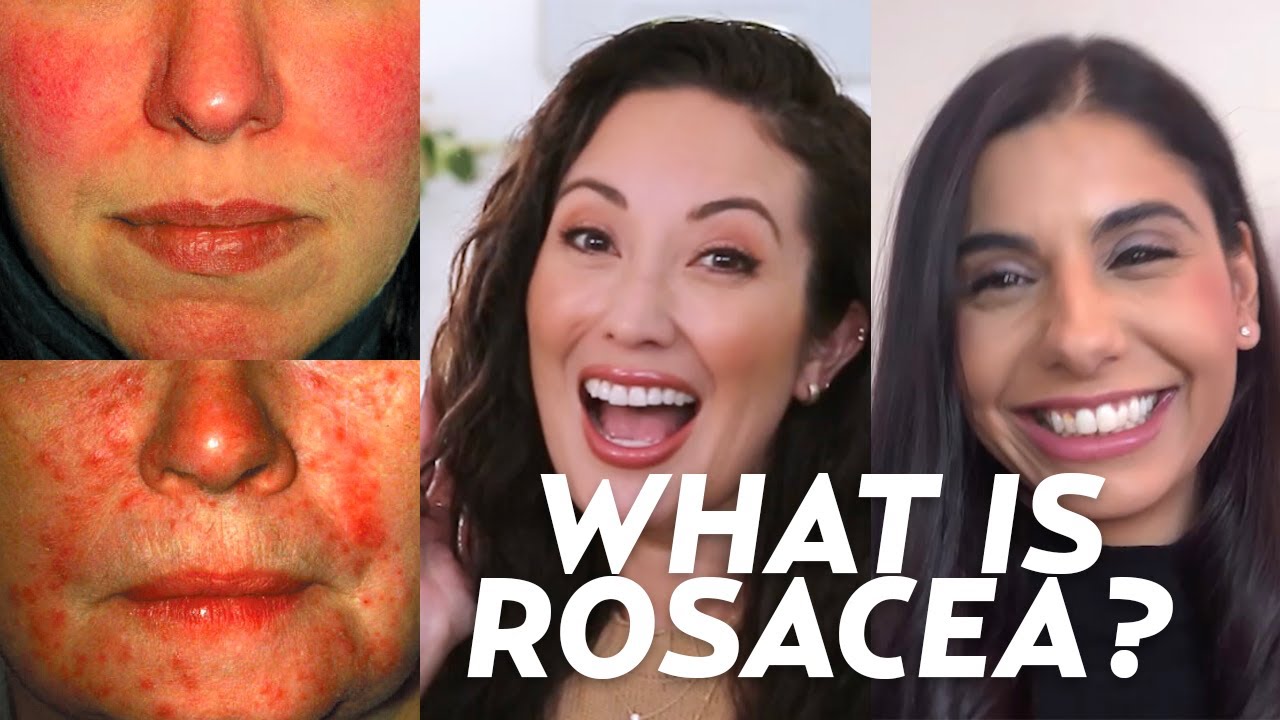 What is Rosacea? We Discuss Symptoms, Causes, & Treatments!