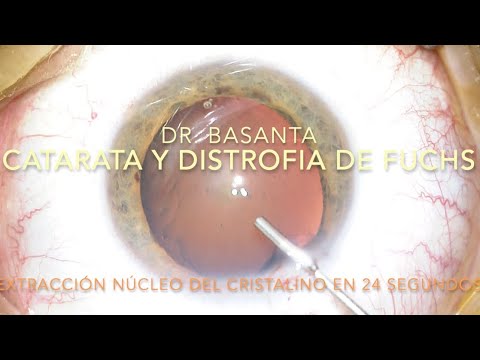 Catarata y distrofia de Fuchs