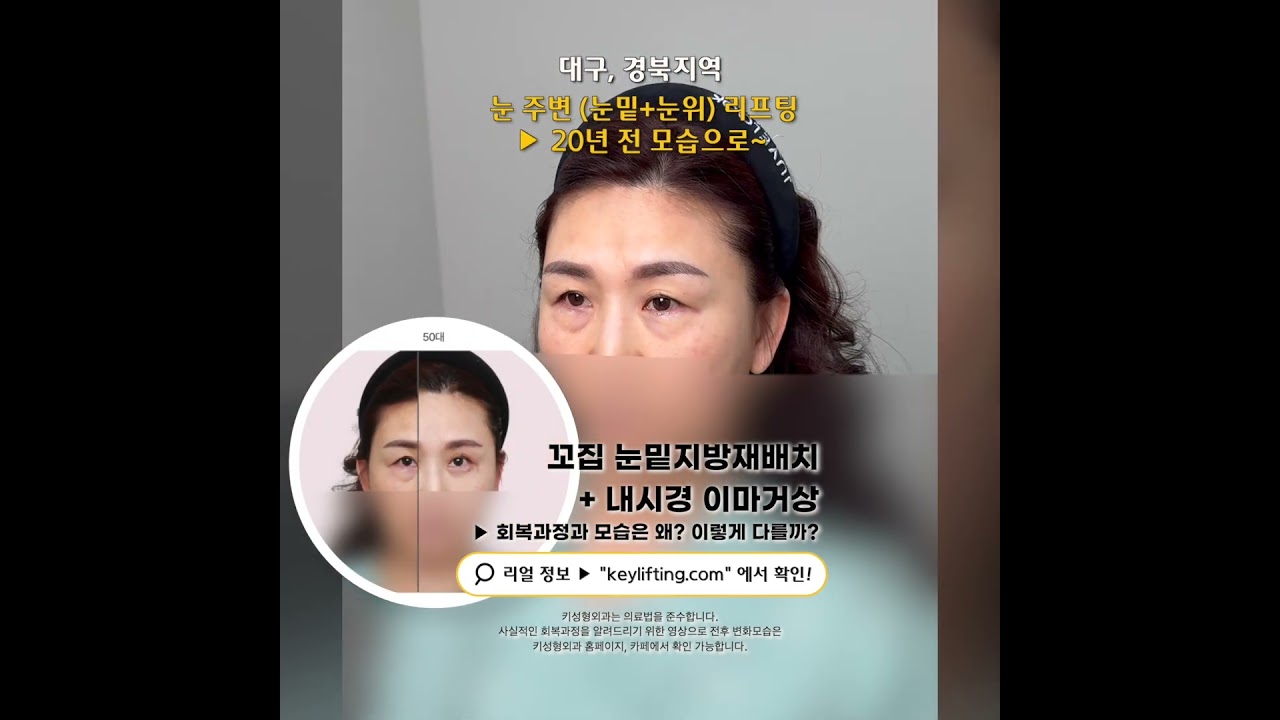 눈주변(눈밑+눈위)리프팅