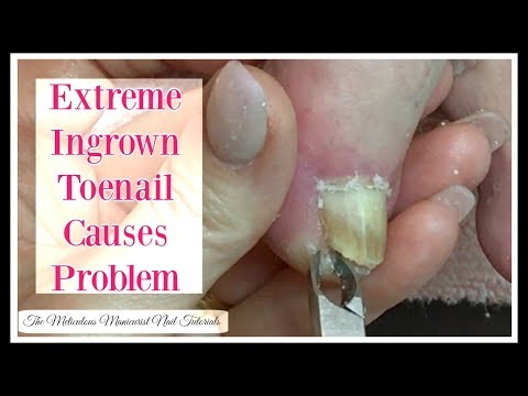 👣 Extreme Ingrown Toenail Causes Problem That Needs To Be Removed Tutorial👣