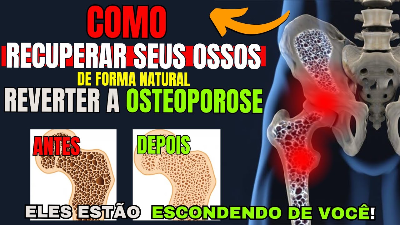 Como REVERTER a OSTEOPOROSE e FORTALECER OSSOS e ARTICULAÇÕES naturalmente