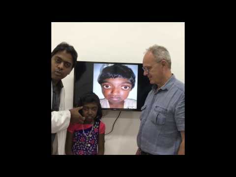LeFort 3 Distraction For Crouzon Syndrome