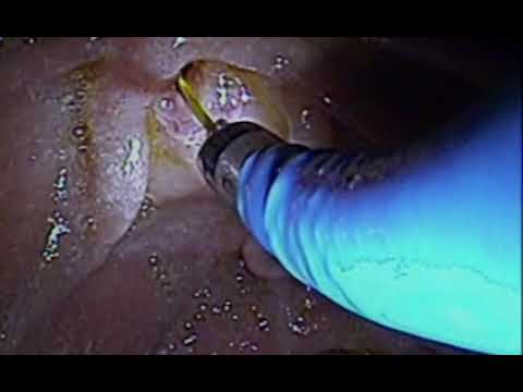 Enterobius vermicularis kțl kurd fertőzés