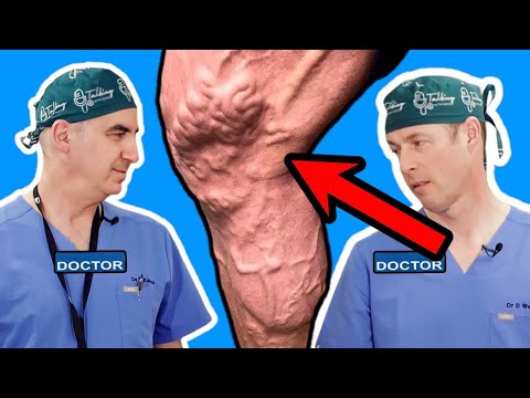 Varicose Veins: How to get rid of them