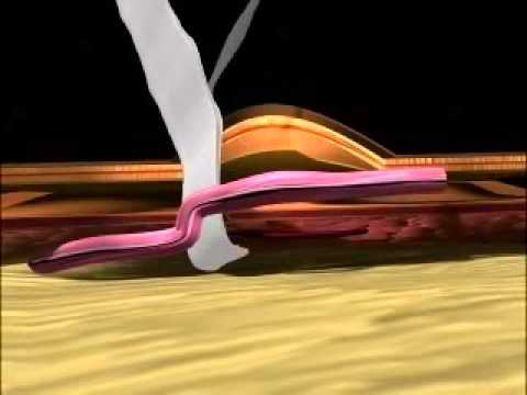 Hernia Surgery Video (3D) by Healing Hands Clinic, Pune