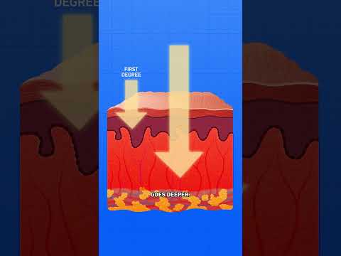 How Do Sunburns Work?