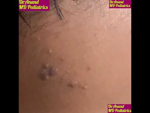 genitális szemölcsök vagy molluscum contagiosum gyorsan távolítsa el a pinwormokat