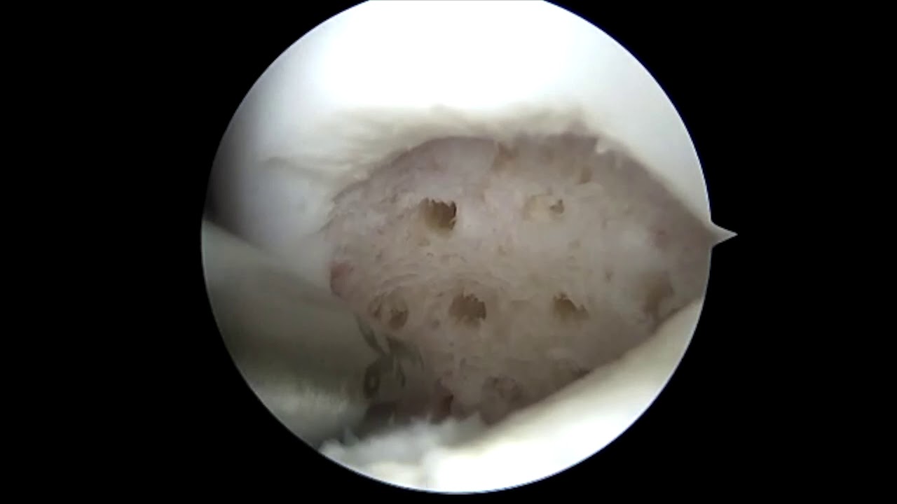 Dr. Garcia demonstrates his arthroscopic technique for knee osteochondritis dissecans (OCD...