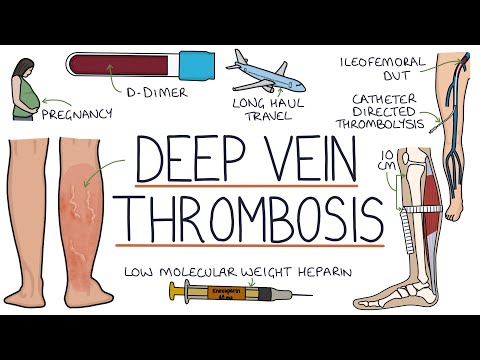Understanding Deep Vein Thrombosis (DVT)