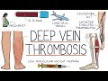 Understanding Deep Vein Thrombosis DVT