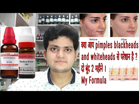 Homeopathic medicine for acne