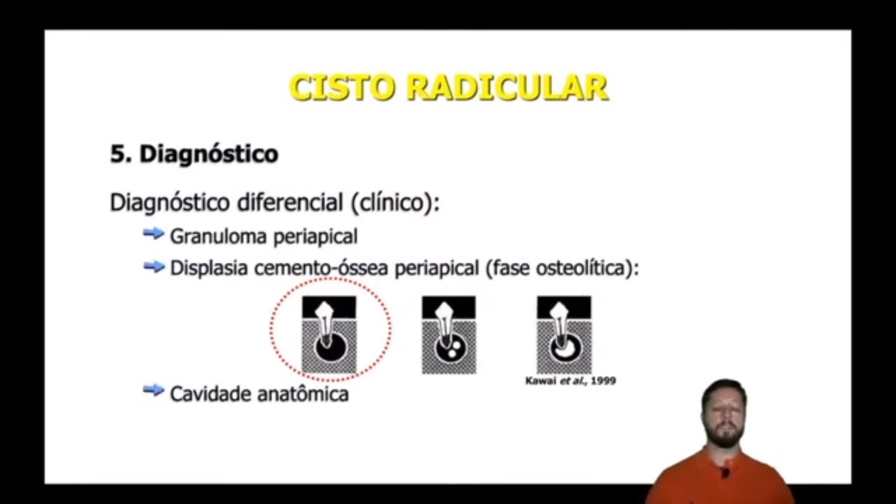Doenças periapicais: cisto radicular e cisto residual