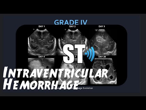 Intraventricular Hemorrhage (Neonatal IVH/Brain Bleed)