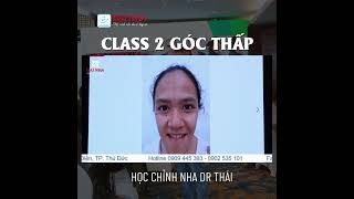Học chỉnh nha - Class 2 góc thấp. Giảng viên bs Hoàng Đức Thái với hơn 26 năm kinh nghiệm chỉnh nha.