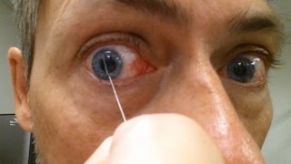 Conjunctivitis: Eye Discharge...Wait for it.....