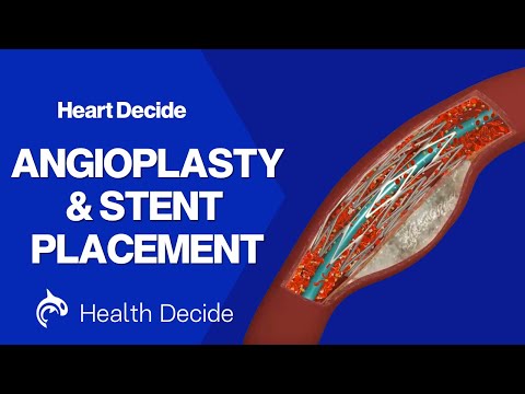 Angioplasty and Stent Placement - 3D Animation
