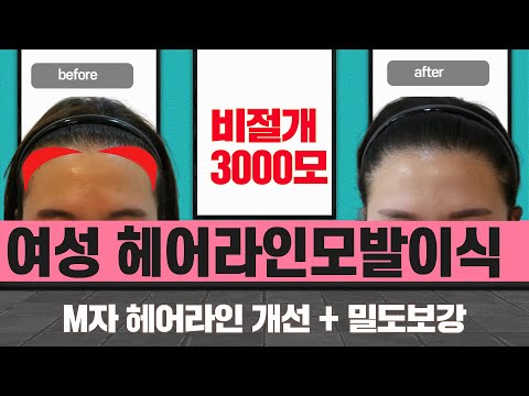 여성헤어라인모발이식 비절개 3000모이식 390만원  모발이식 사진 올림머리 라인도 자연스럽습니다.