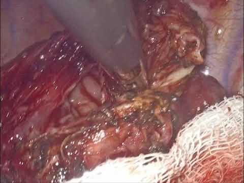 Laparoscopic TAPP Repair of Inguinal Hernia