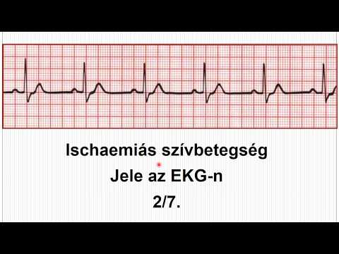 Az EKG felfedi a magas vérnyomást)