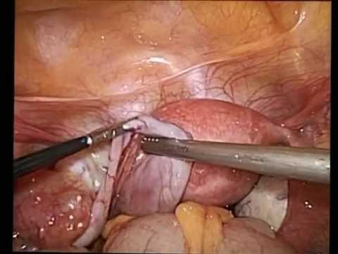 Dolore alla spalla nei muscoli delle articolazioni Trasversale Articulatio giunto