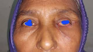 BCC- Basal Cell Carcinoma at lower eyelid- Reconstruction with Cheek Advancement