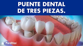 Puente dental de tres piezas ©
