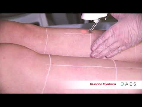 Laser Hair Removal Utlising the Quanta System Laser Platform