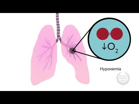 How Anesthesiologists Can Help With Transfusion related Acute Lung Injury