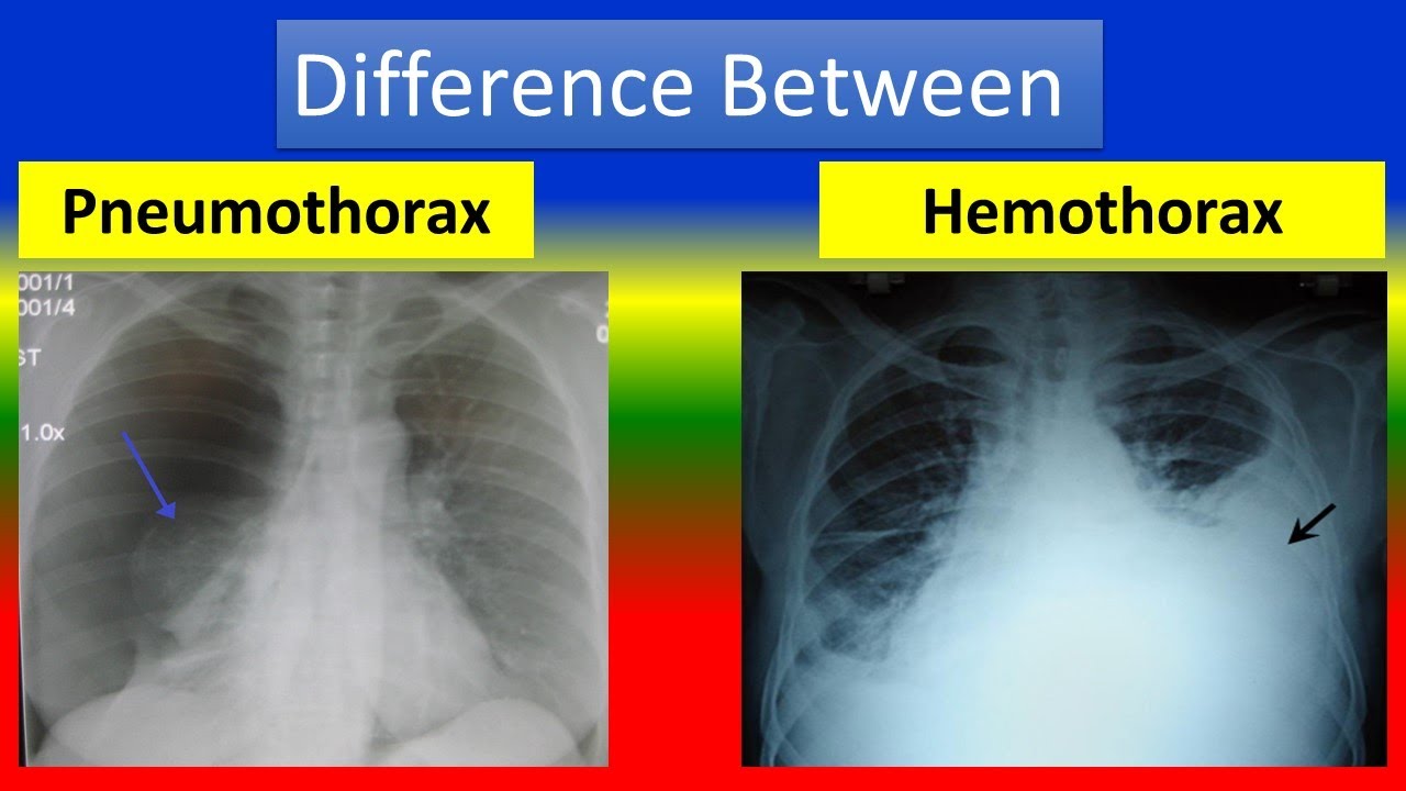 What is the difference between a pneumothorax and a Hemothorax? – EN ...