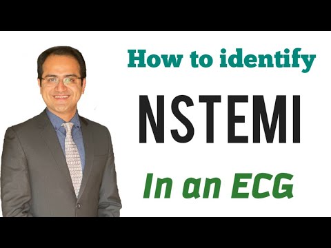 NSTEMI (Subendocardial Ischemia) ECG Changes Explained, Myocardial Infarction(MI) ECG Interpretation